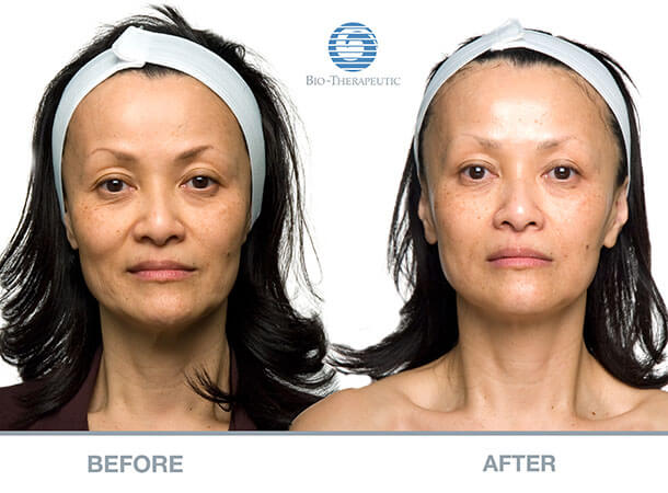 Microcurrent Facials Before and After